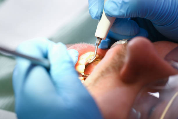 Best Dentist for Tooth Abscess  in Logan, NM